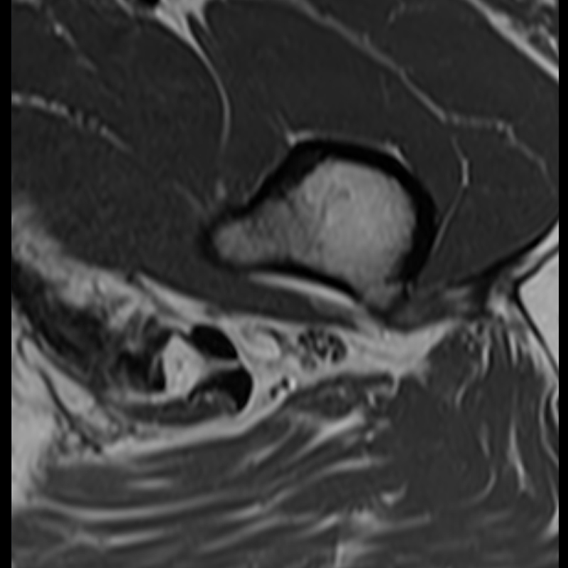 Sciatic Nerve