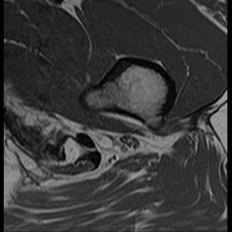 Sciatic Nerve