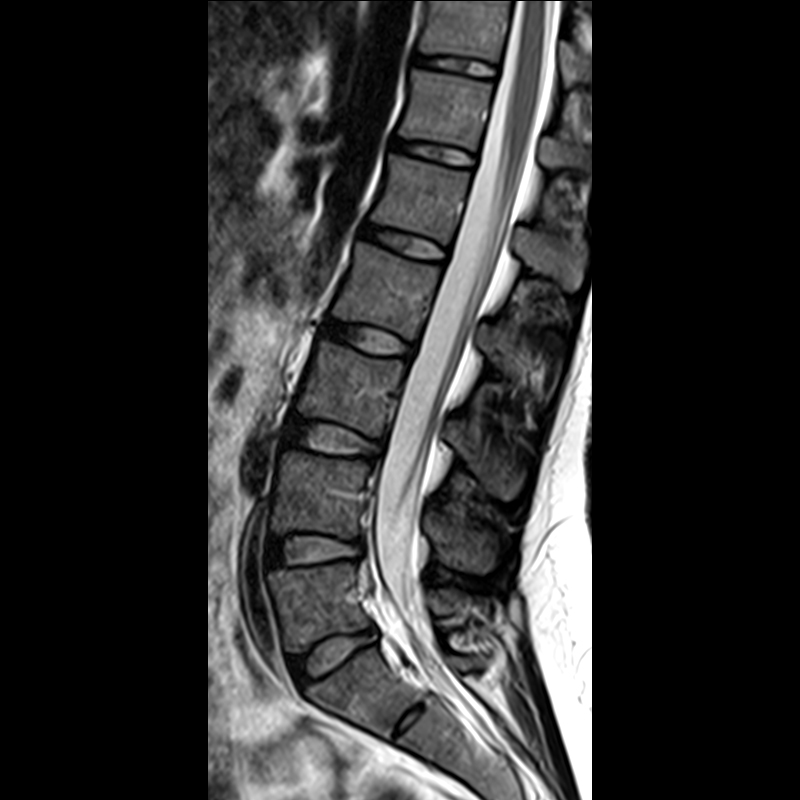 Lumbar Spine