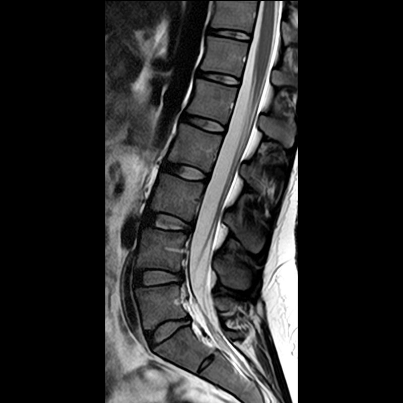 Lumbar Spine